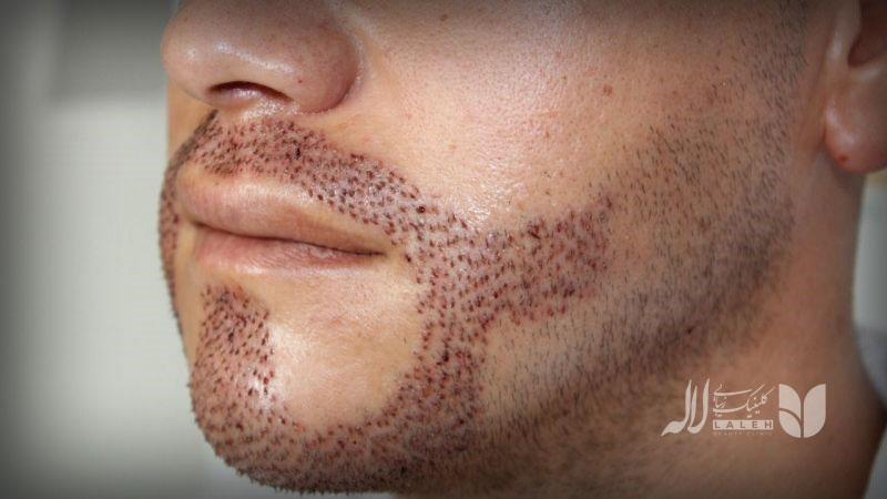 کاشت ریش و سبیل