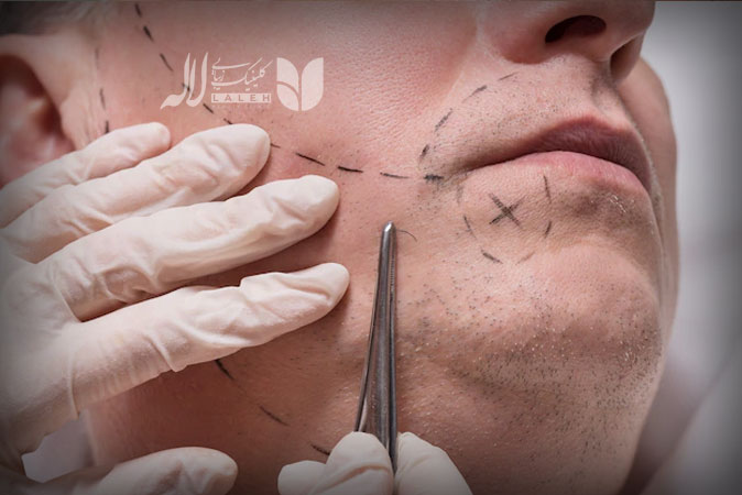 کاشت ریش و سبیل
