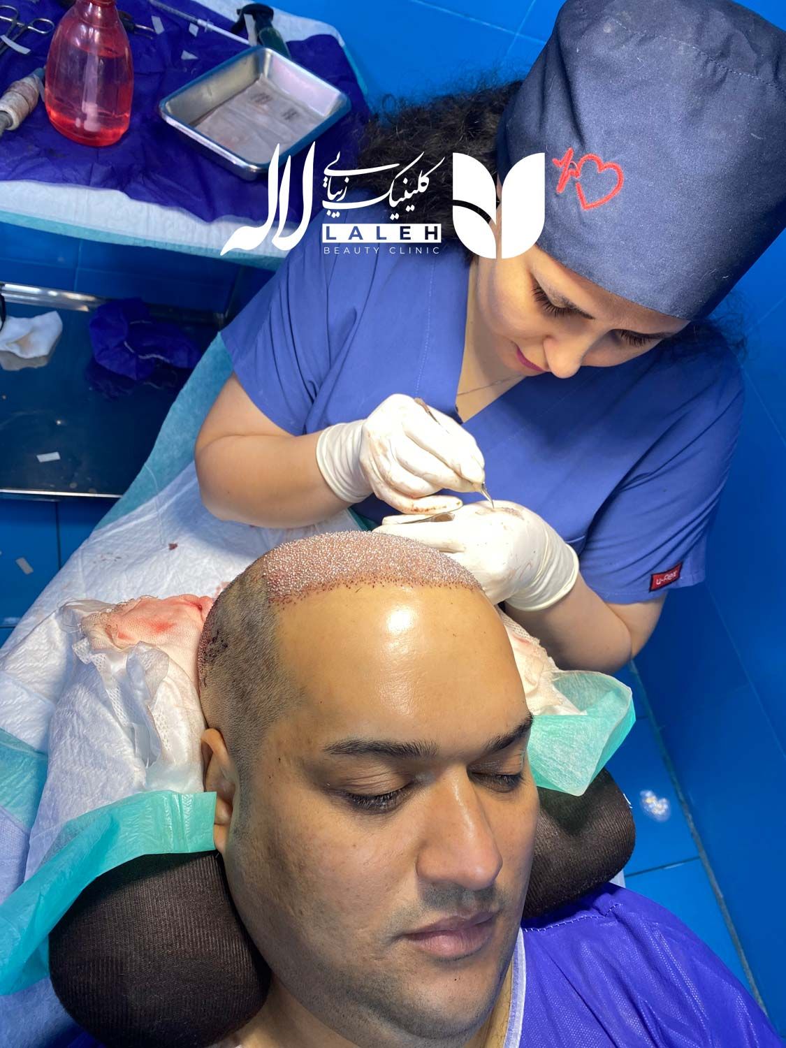 نمونه کاشت مو