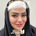 کاشت ابرو