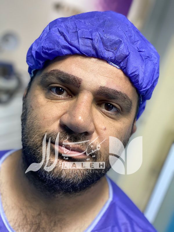 کاشت ابرو برای آقایان
