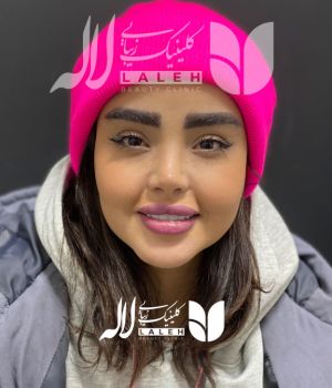 کاشت ابرو