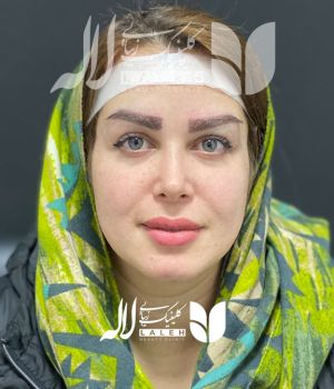 کاشت ابرو