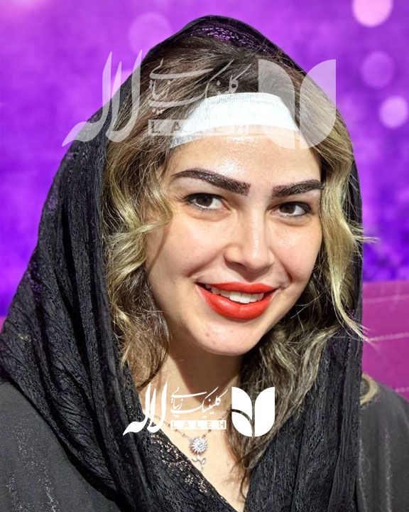 کاشت ابرو