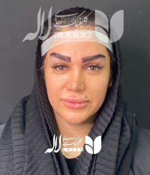 کاشت ابرو