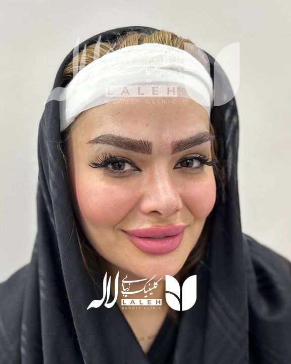 کاشت ابرو