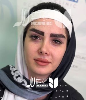 کاشت ابرو