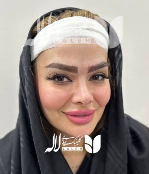 کاشت ابرو