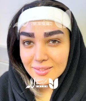 کاشت ابرو