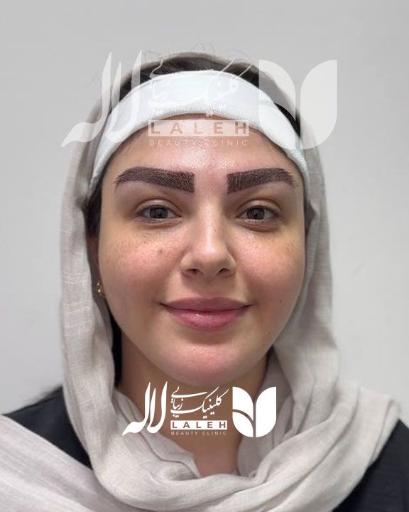 کاشت ابرو