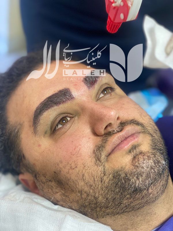 کاشت ابرو برای آقایان