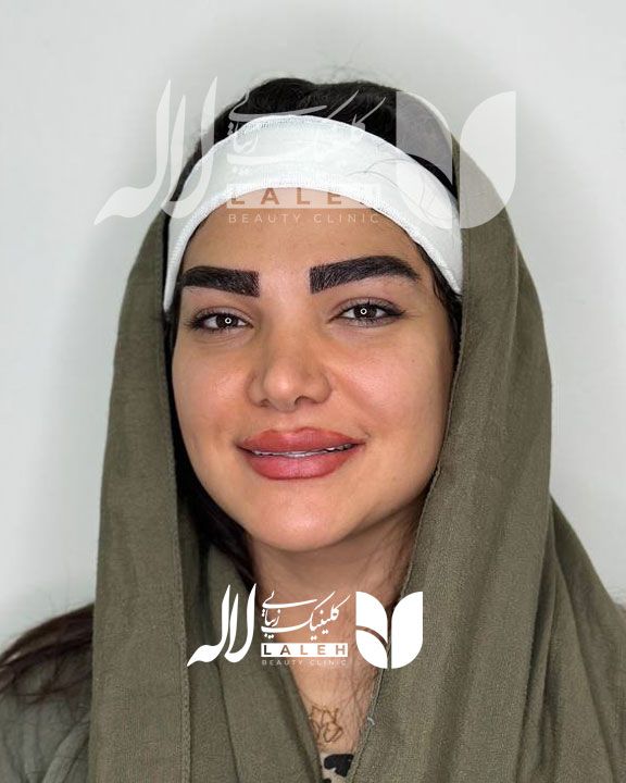 کاشت ابرو