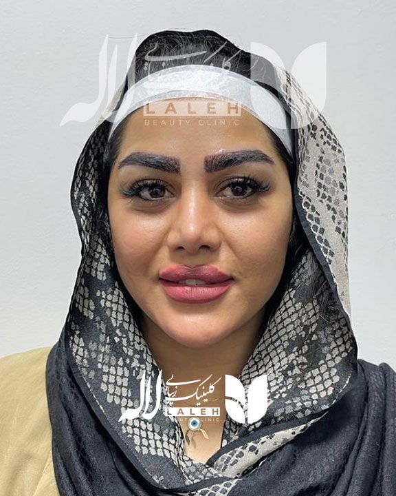 کاشت ابرو