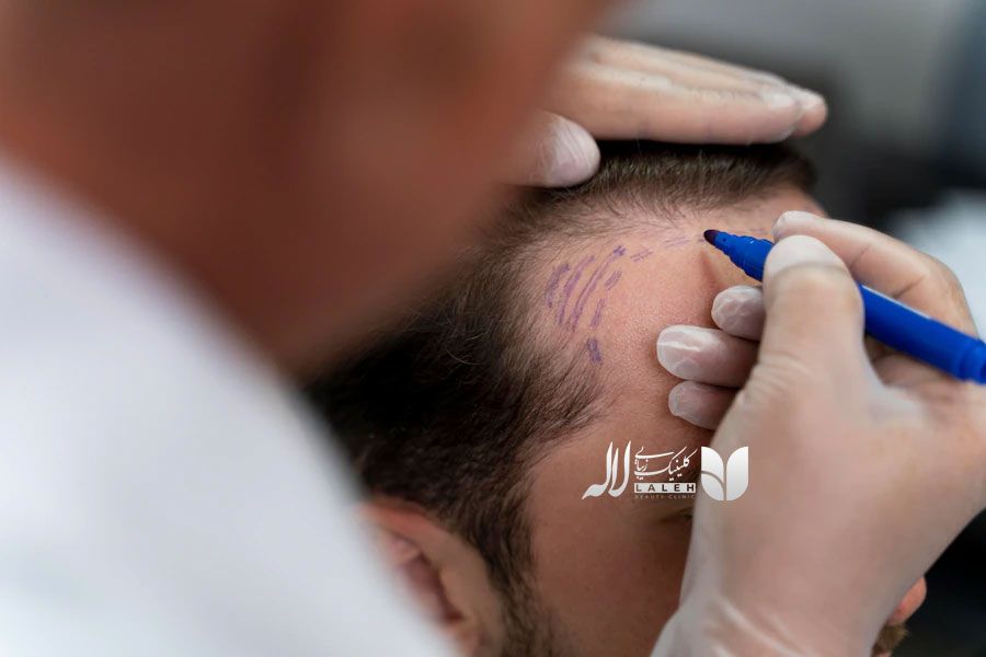 کاشت مو کلینیک لاله