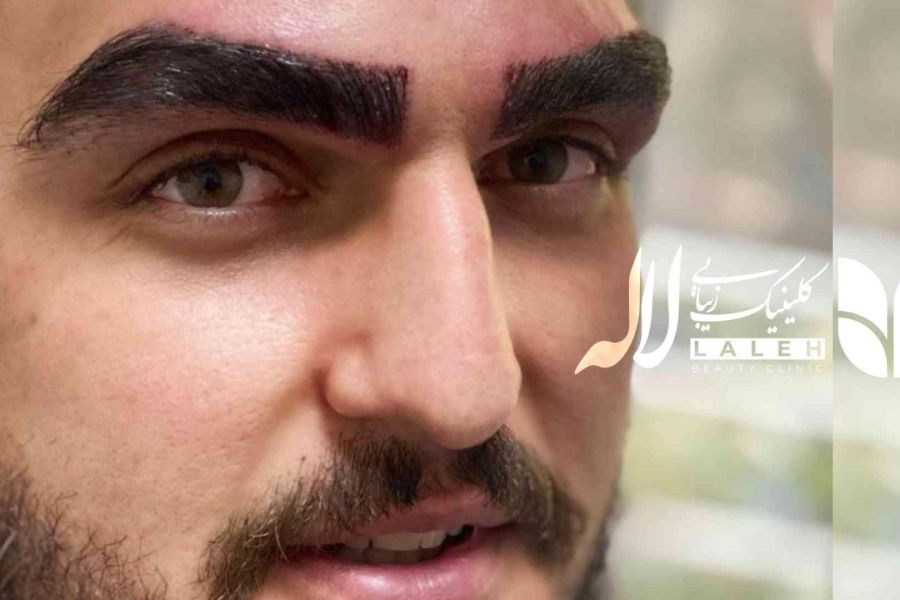آیا آقایان هم می توانند کاشت ابرو انجام دهند ؟
