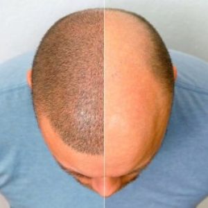 10 کاری که باید پیش از کاشت مو انجام بدهیم