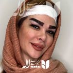 کاشت ابرو