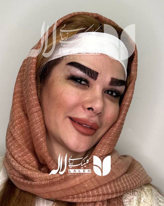کاشت ابرو