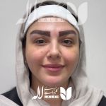 کاشت ابرو
