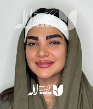 کاشت ابرو