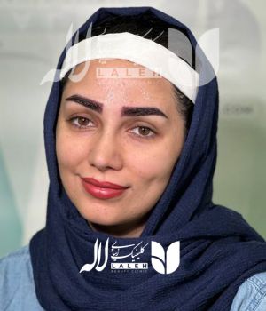 کاشت ابرو