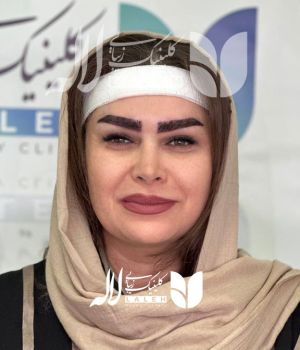 کاشت ابرو