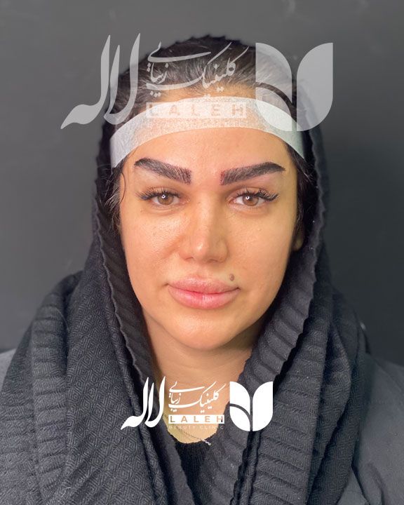 کاشت ابرو