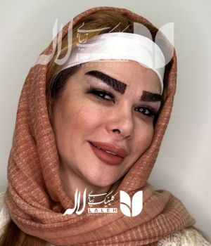 کاشت ابرو