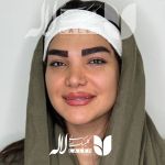کاشت ابرو