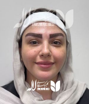 کاشت ابرو