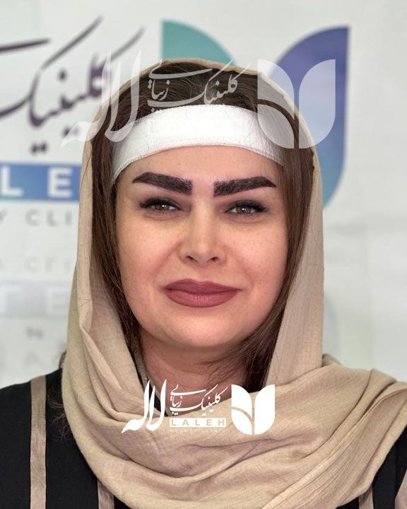 کاشت ابرو
